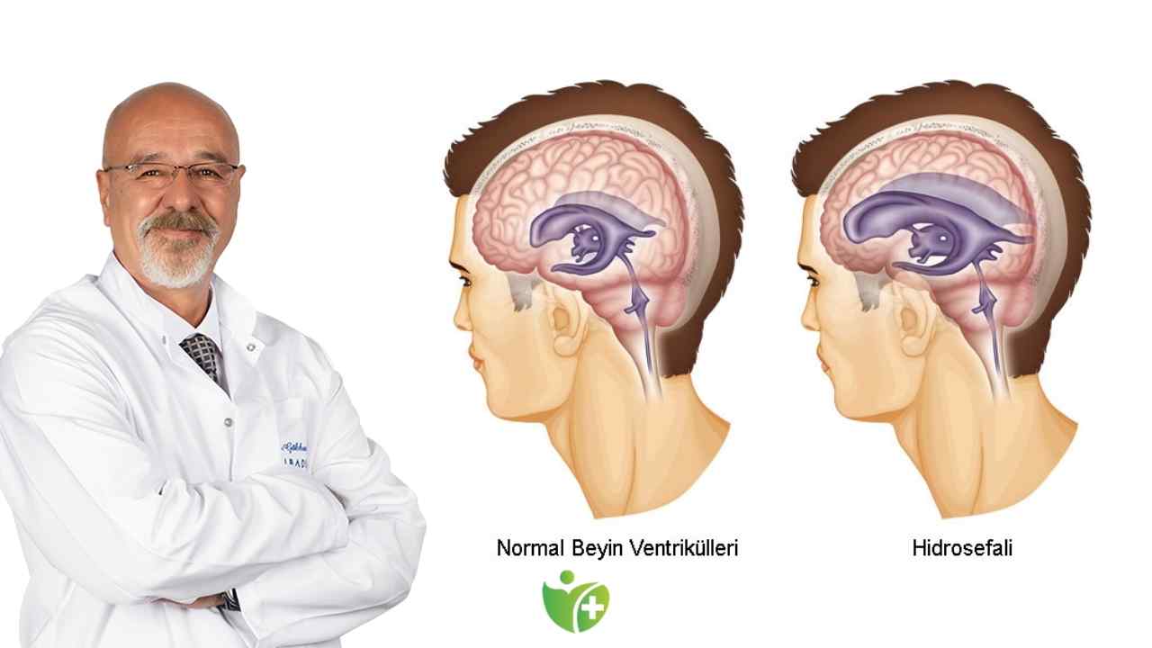 Yaşlılık döneminde gözden kaçabilen sinsi hastalık Hidrosefali! 7