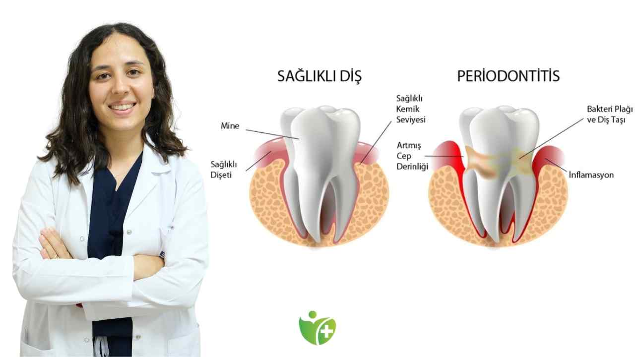 Diş taşı tedavi edilmezse enfeksiyona neden olabiliyor 7