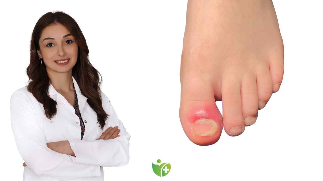 Tedavi edilmeyen Tırnak batması Enfeksiyon riskine yol açabilir! 7