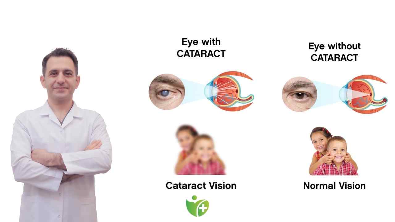 Katarakt hakkında Bilinen Yanlışlar ve Bilimsel gerçekler! 7