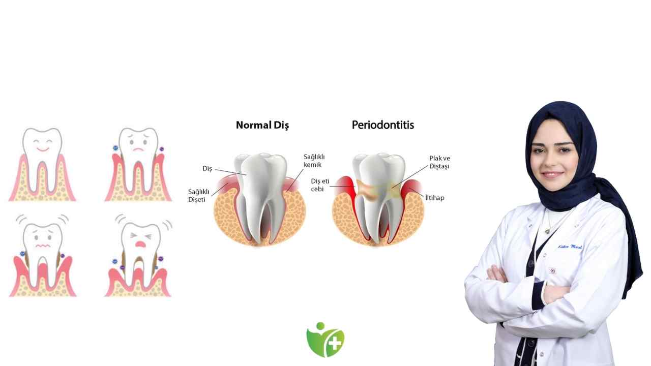 Diş eti hastalıkları ve Kalp Sağlığı arasındaki bağ 7