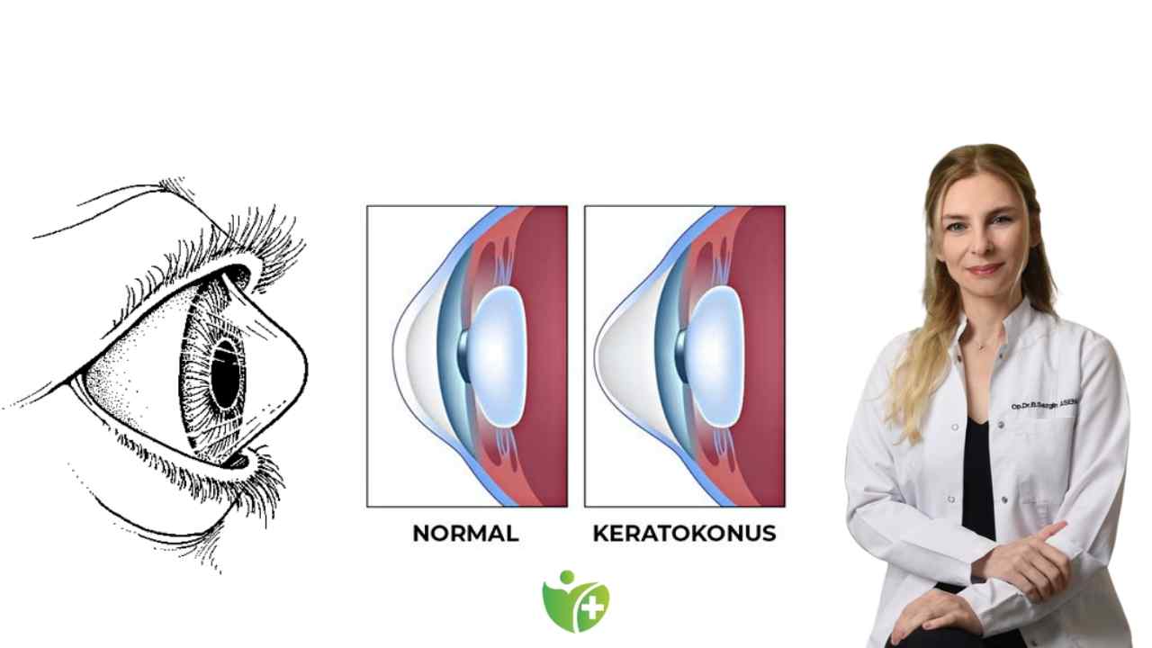 Gençlerde Keratokonus görülme oranı neden yüksek? 7