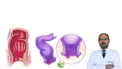 Makat Çatlağı Ağrısını anında hafifleten 6 yöntem 1
