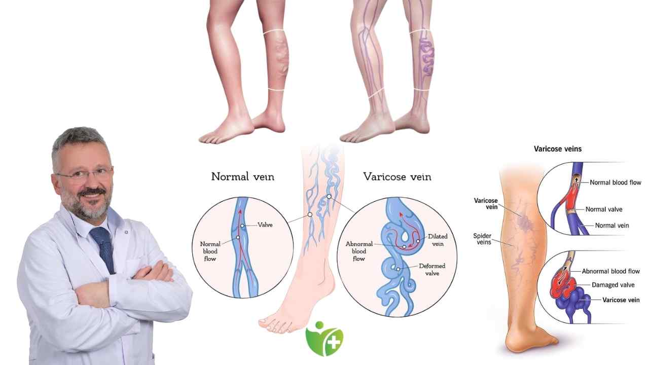 Varis sadece bacaklarınızı değil, Akciğerlerinizi de tehdit ediyor! 7