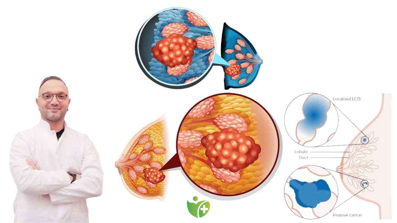 Meme kanserinde erken tanının hayat kurtaran önemi 7