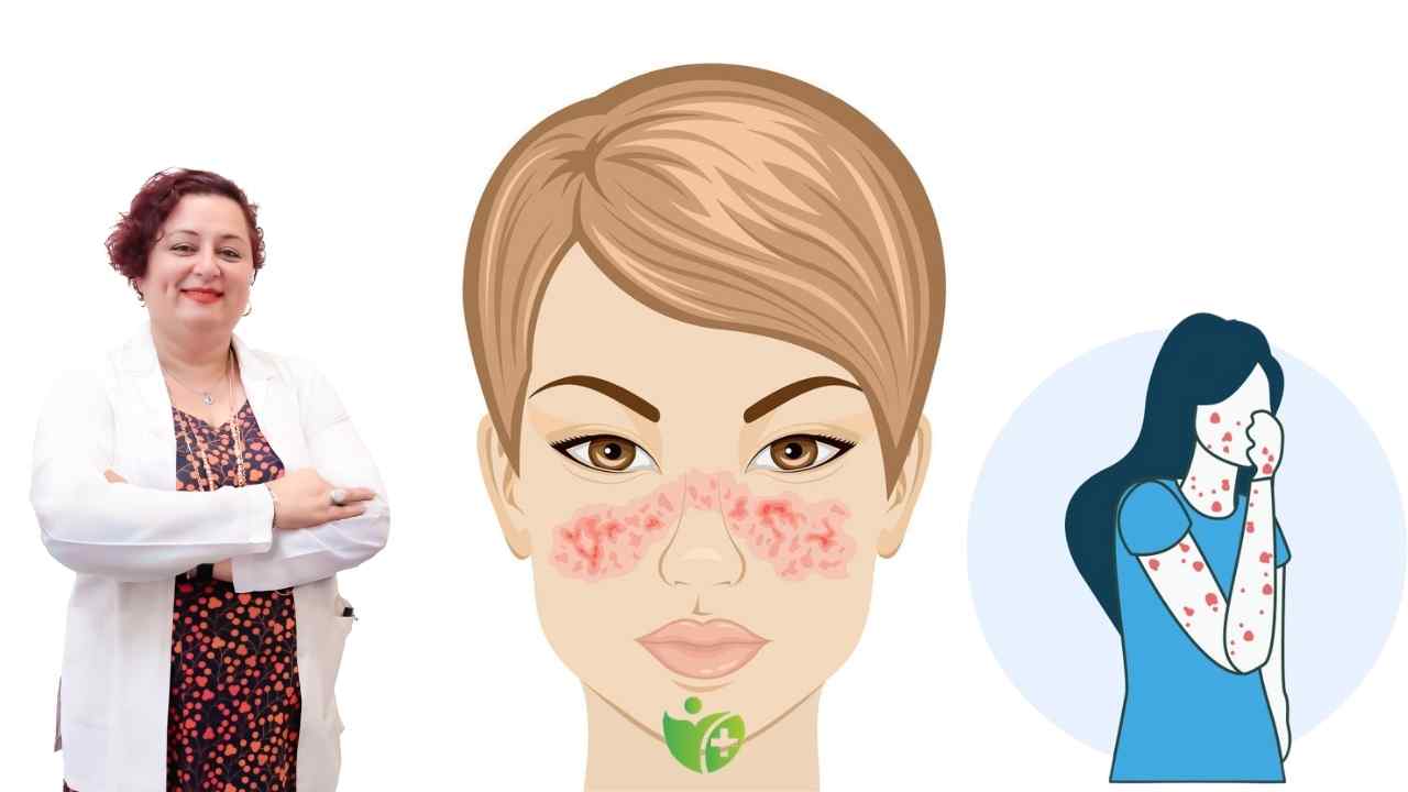 Yüz lekeleri Lupus habercisi mi? İşte dikkat etmeniz gerekenler! 7