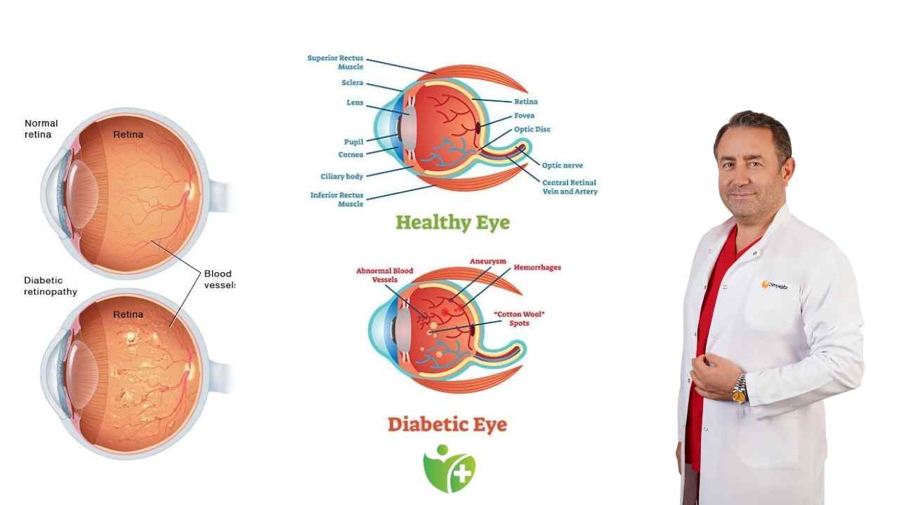 Şeker hastaları dikkat! Diyabetik Retinopati genç yaşta körlüğe yol açıyor 7