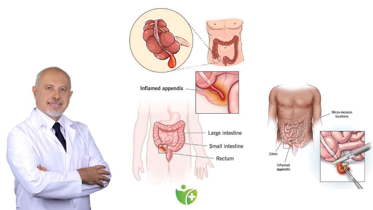 Sıcaklar Apandisiti tetikliyor! İşte kritik belirtiler ve korunma yolları 7
