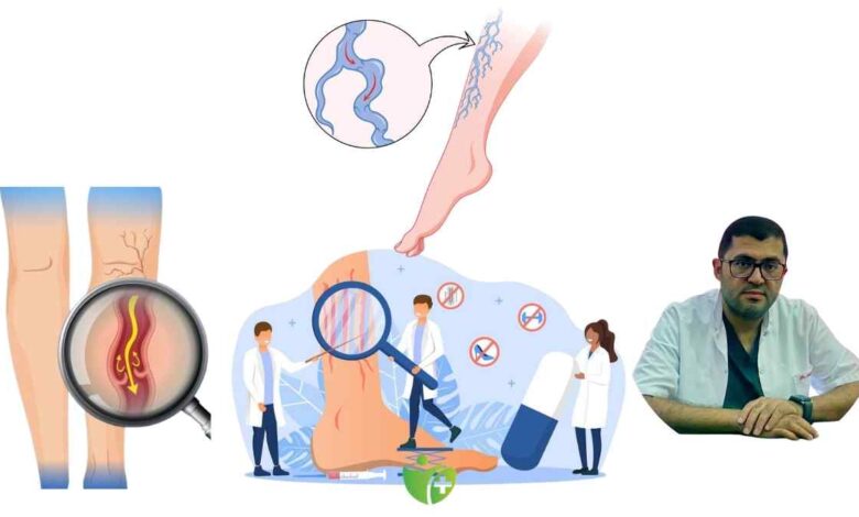 Varis hastalarına yaz uyarısı: Sıcaklarda şikayetleri azaltacak 10 Pratik çözüm 1