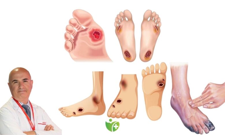 Yaz sıcakları Diyabetik ayak riskini artırıyor: İşte 8 hayat kurtaran tavsiye 1