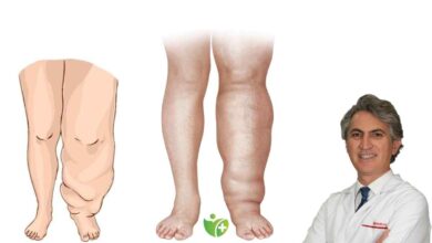 Yaz aylarında Lenfödem şikayetlerini azaltmak için 10 hayat kurtaran öneri 1