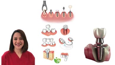 Diş implantı yaptırmadan önce mutlaka bilmeniz gereken 9 şey 16