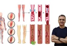 Stent Trombozu nedir? Stent sonrası en ciddi komplikasyon ve korunma yolları 26