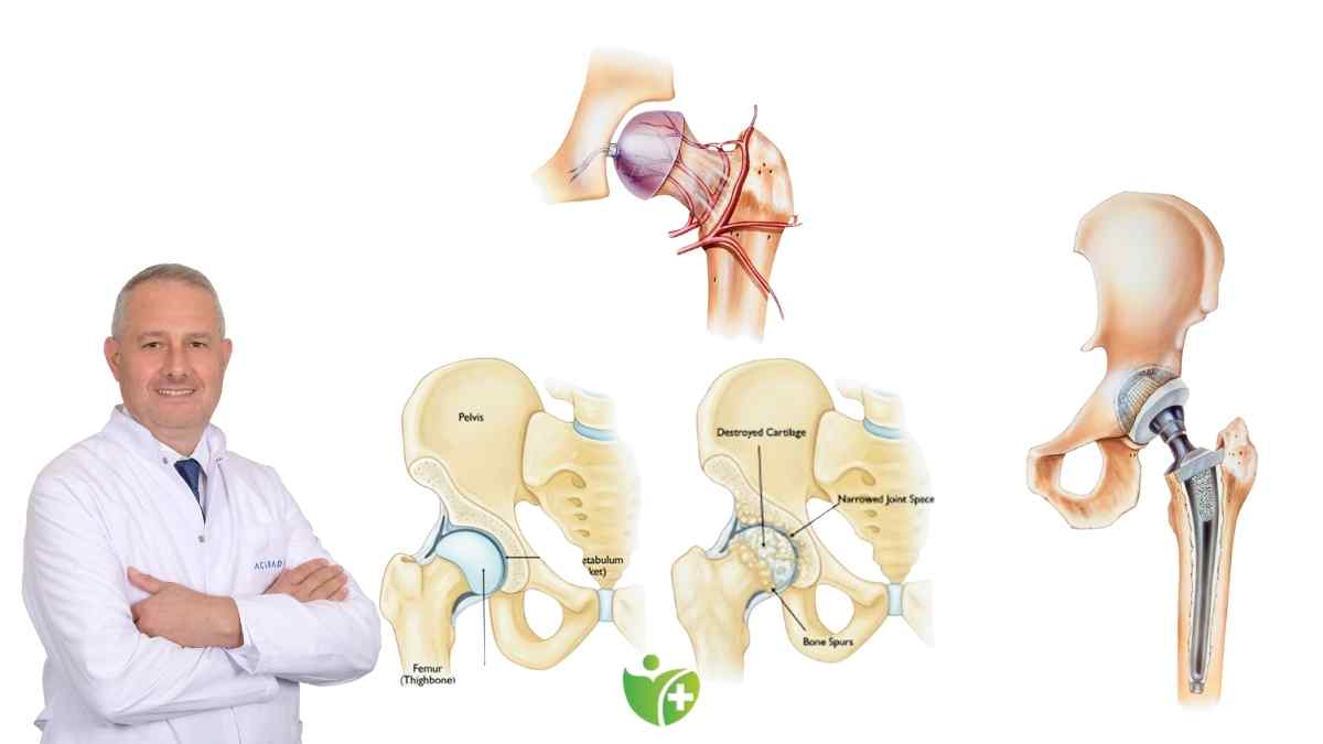Kalça Protezi Ameliyatı: Kimler için uygun ve nasıl uygulanır? 7
