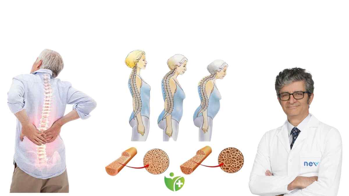 Kemikleriniz sessizce eriyor olabilir! Osteoporozun işaretlerini tanıyın 7
