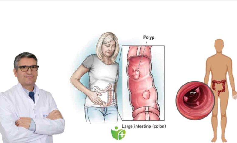 Vücudunuzu Poliplere karşı korumak için 8 hayat tarzı değişikliği 5