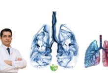 Akciğer kanseri vakaları alarm veriyor: Yılda 41 bin yeni hasta! 14