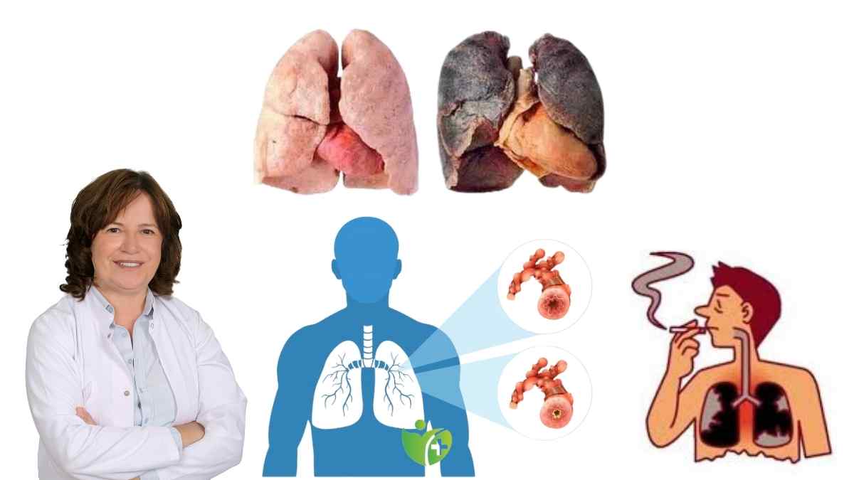 KOAH neden bu kadar yaygınlaştı? İşte şok eden gerçekler 7