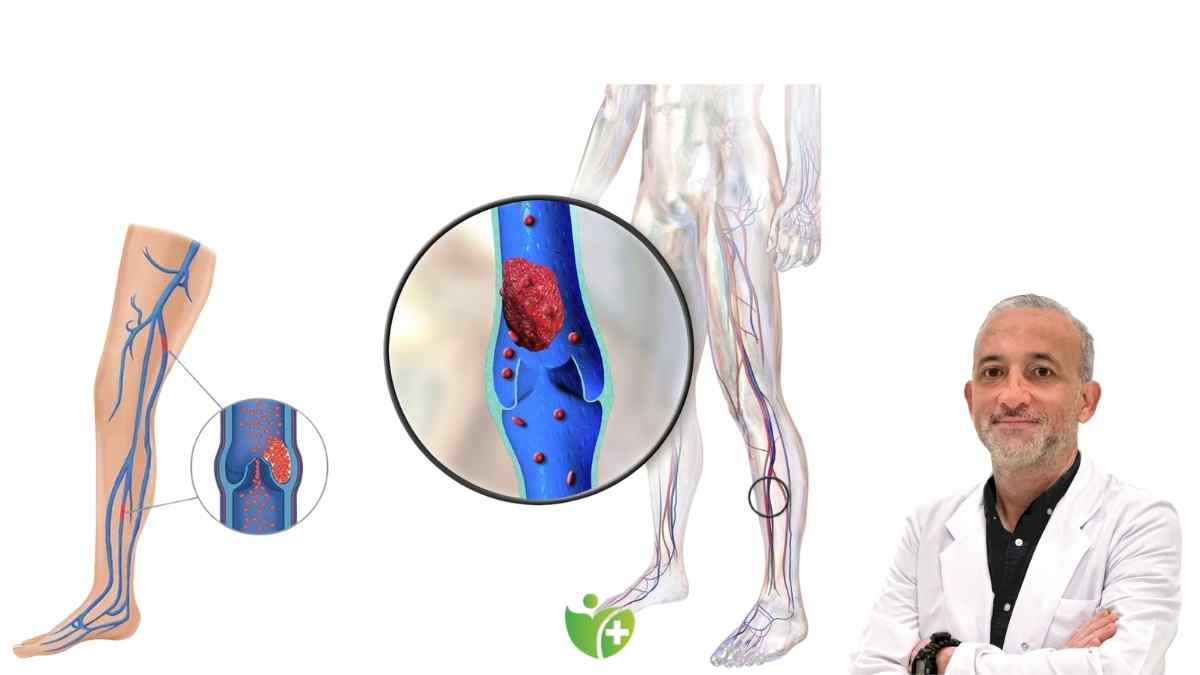 Bacaklardaki Varis ve Ağrılar ileride daha büyük sorunlara işaret ediyor 7