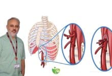 Arkuat Ligaman Sendromu artık Robotik cerrahiyle tedavi ediliyor 23