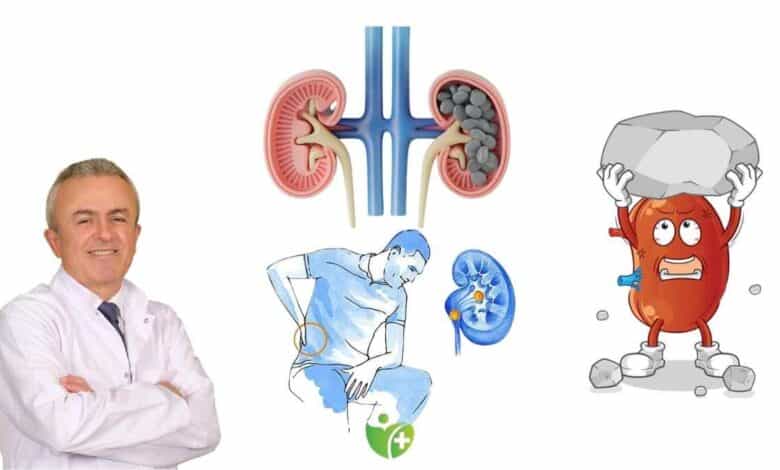 Neden kışın daha fazla Böbrek taşı oluşur? İşte şaşırtıcı sebebi 1