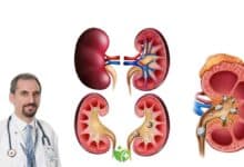 C Vitamini takviyeleri ve Oksalat: Böbrek Taşı riskini nasıl artırıyor? 6