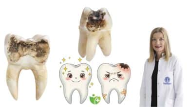 Diş çürükleri neden sessizce ilerler? Mine ve Dentin tabakalarındaki yıkım 1