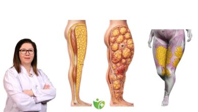 "Yağlı Bacak" Sendromu: Lipödem nedir ve nasıl anlaşılır? 3