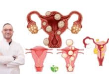 Miyom belirtileri nelerdir? Ağır kanama ve Ağrı şikayeti olmayabilir 2