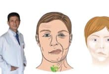 Yüz Felci (Fasiyal Paralizi) ile Soğuk hava ilişkisi: Gerçek mi, Efsane mi? 29