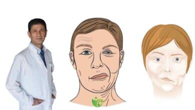 Yüz Felci (Fasiyal Paralizi) ile Soğuk hava ilişkisi: Gerçek mi, Efsane mi? 1