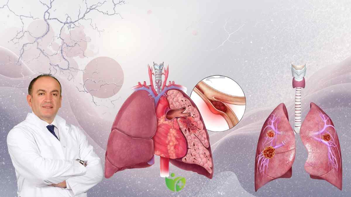 Akciğer Sönmesi artık 15-34 yaş aralığının hastalığı 7