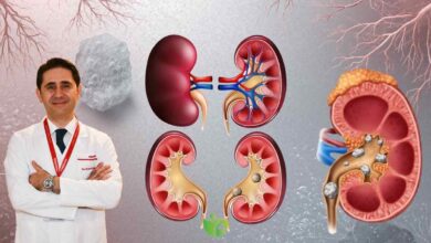 Böbrek Taşı oluşumunu önlemenin 4 etkili yöntemi 1