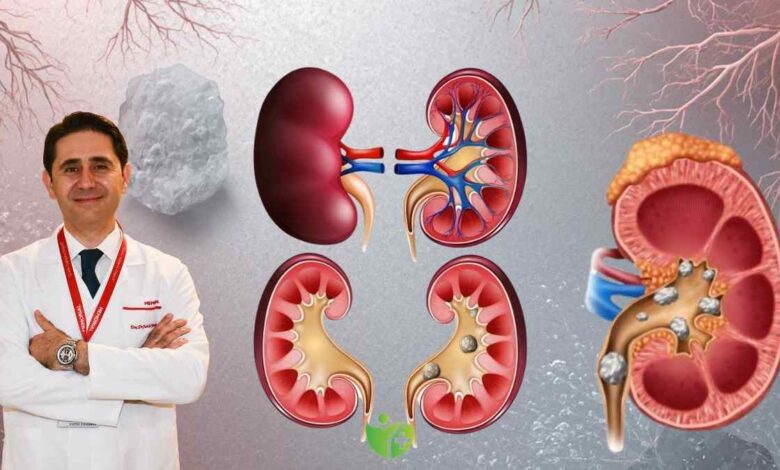 Böbrek Taşı oluşumunu önlemenin 4 etkili yöntemi 1