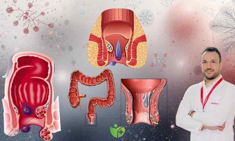 Hemoroid sandığınız belirtiler başka hastalıkların habercisi olabilir 1