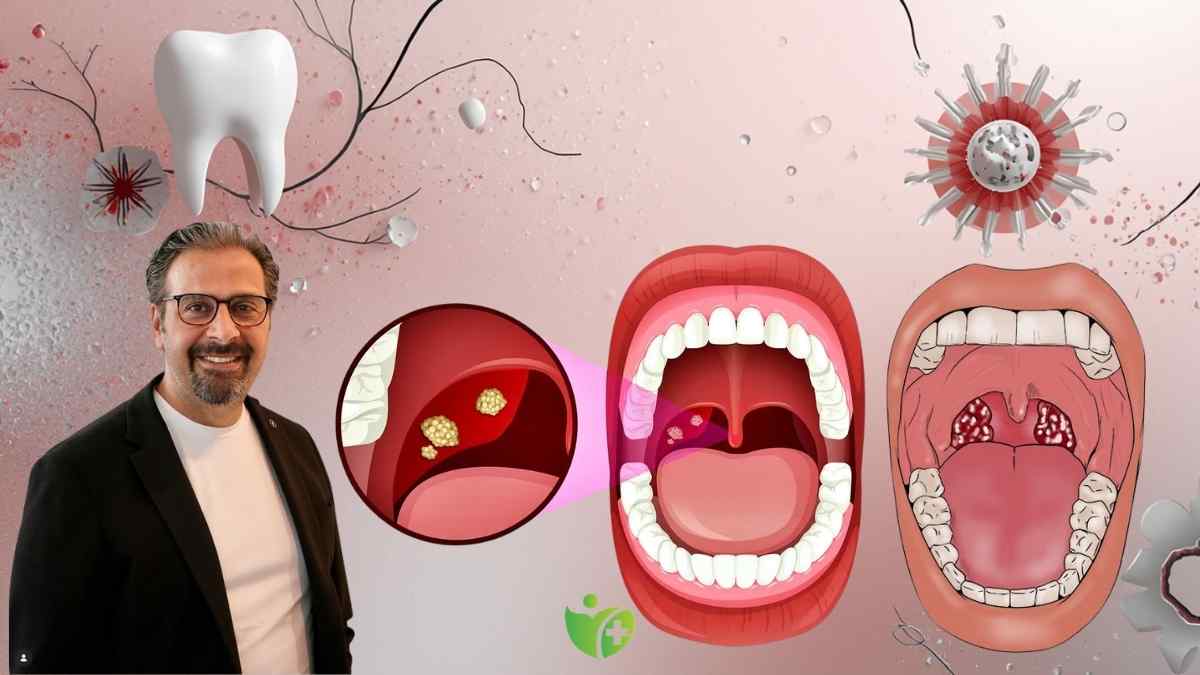 Geçmeyen Ağız kokusunun nedeni Bademcik taşları olabilir 7