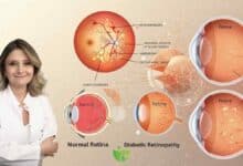 Diyabet Göz sağlığını nasıl tehdit ediyor? 4