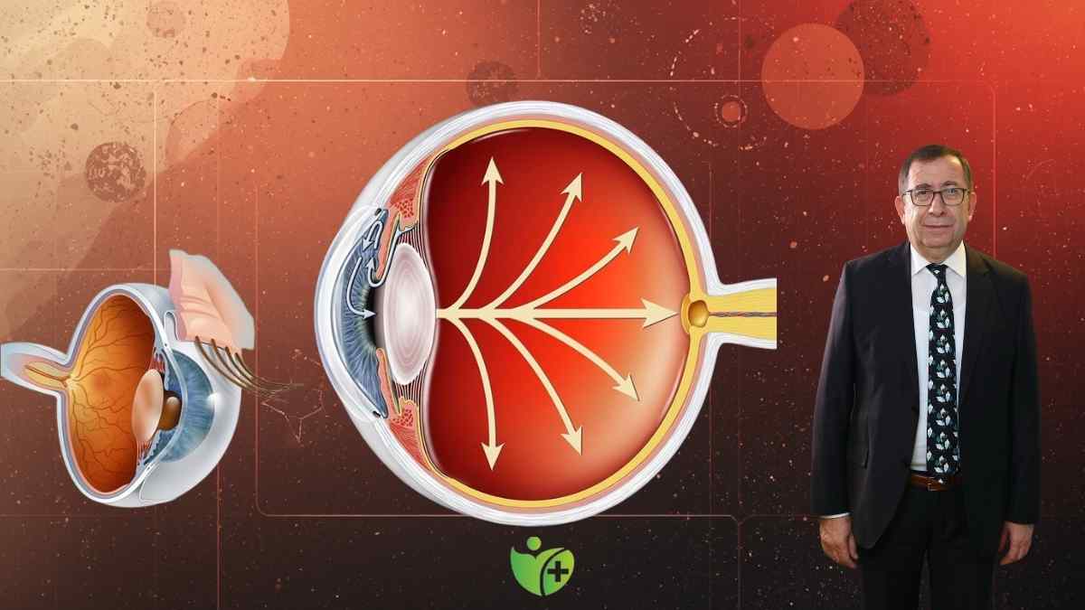 Göz Tansiyonu (Glokom) Körlüğe yol açmadan önlem alın 7