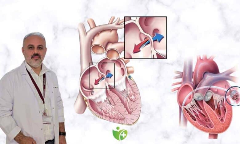 Kalp Kapak hastalıklarında Robotik Cerrahi dönemi 1