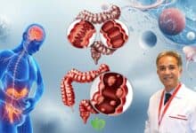 Kolon Kanserinden korunmak için bilmeniz gereken 7 risk faktörü 5