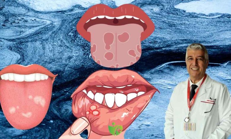 Ağızda 3 haftadan uzun süren yara Ağız Kanseri belirtisi olabilir 1