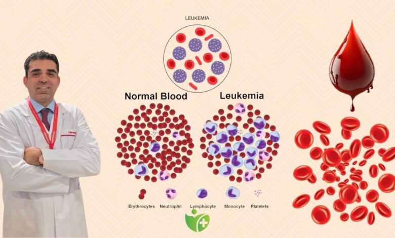 Lösemi Çocuklarda en sık görülen Kanser türü 1