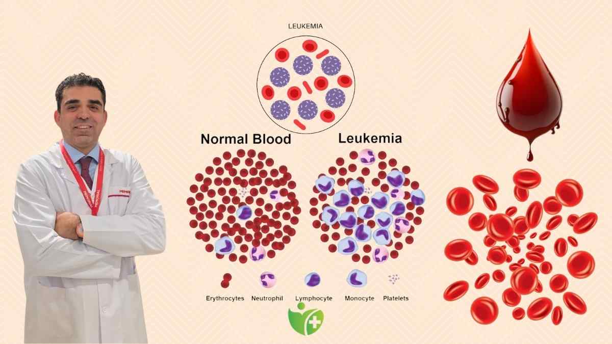 Lösemi Çocuklarda en sık görülen Kanser türü 7