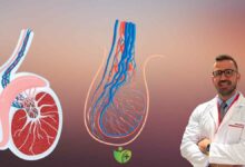 Varikosel nedir? Erkeklerde sık görülen bu soruna Dikkat! 3
